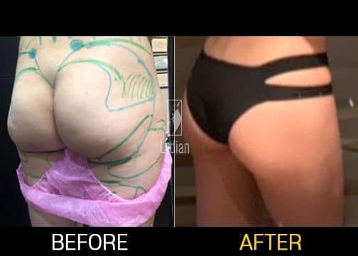 liposuction-hips-and-thighs