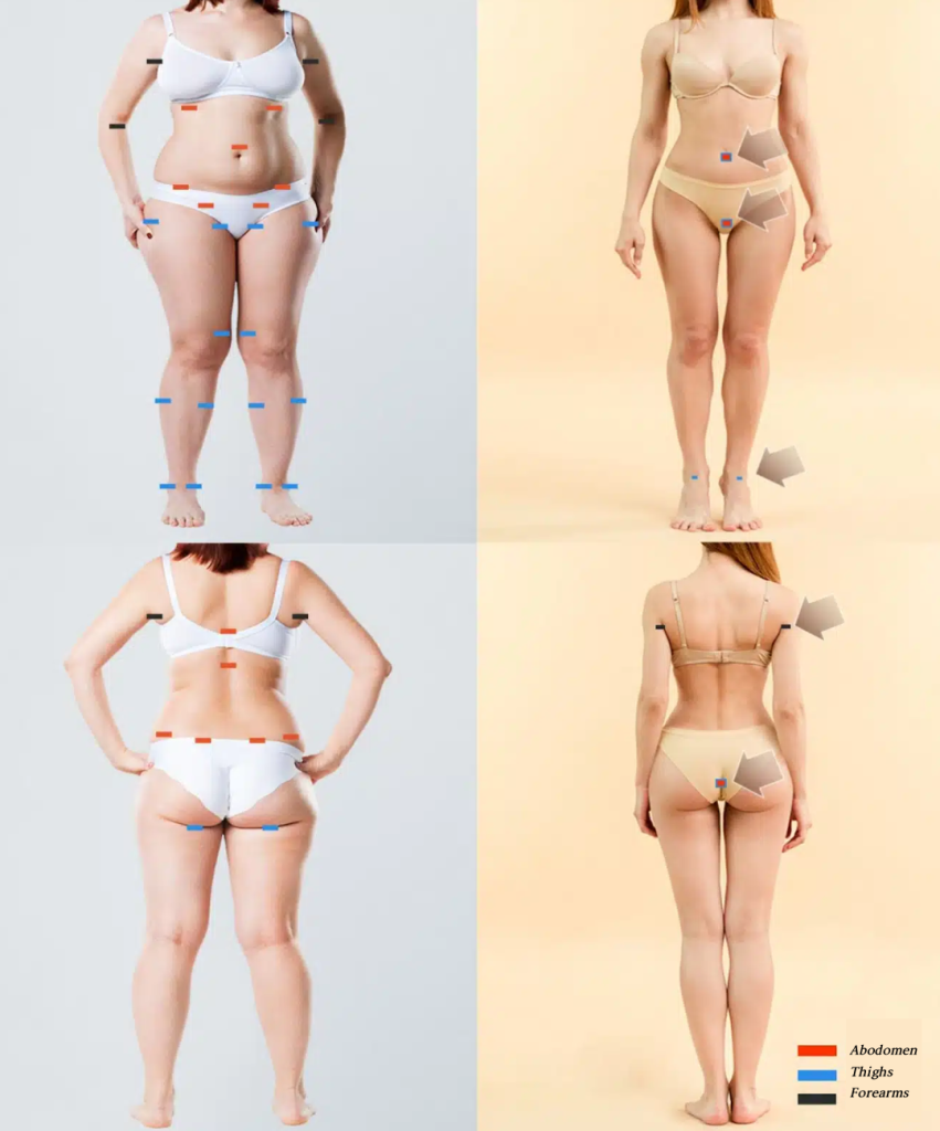 thigh-liposuction-results-week-by week