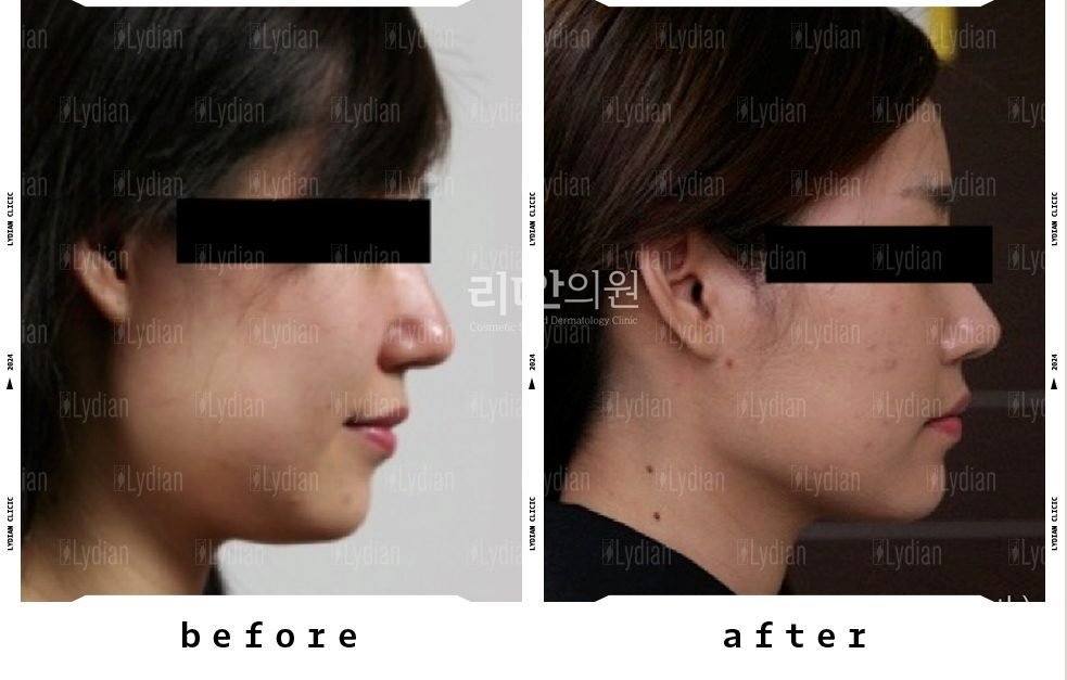 facial-liposuction-before-after