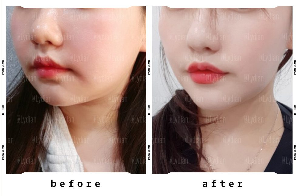 chin-liposuction-korea