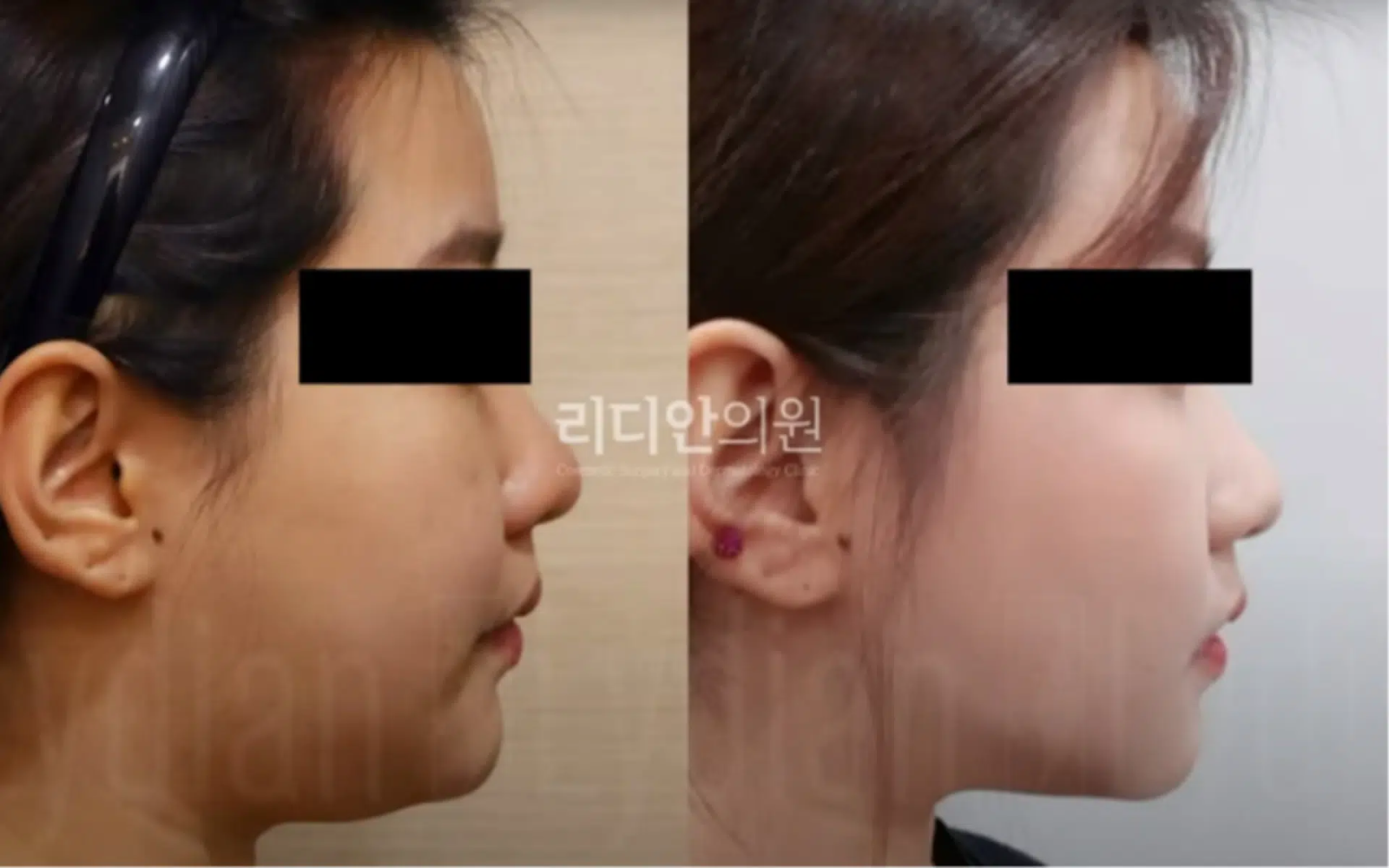 facial-liposuction-before-and-after