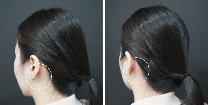 how long does it take to heal from chin liposuction