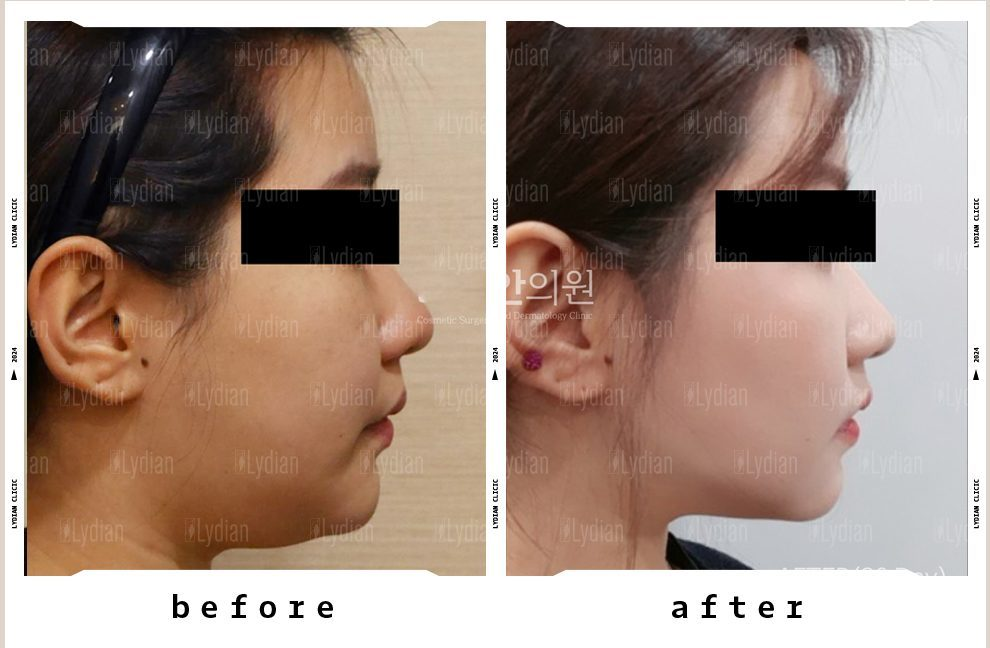 chin-liposuction-before-and-after