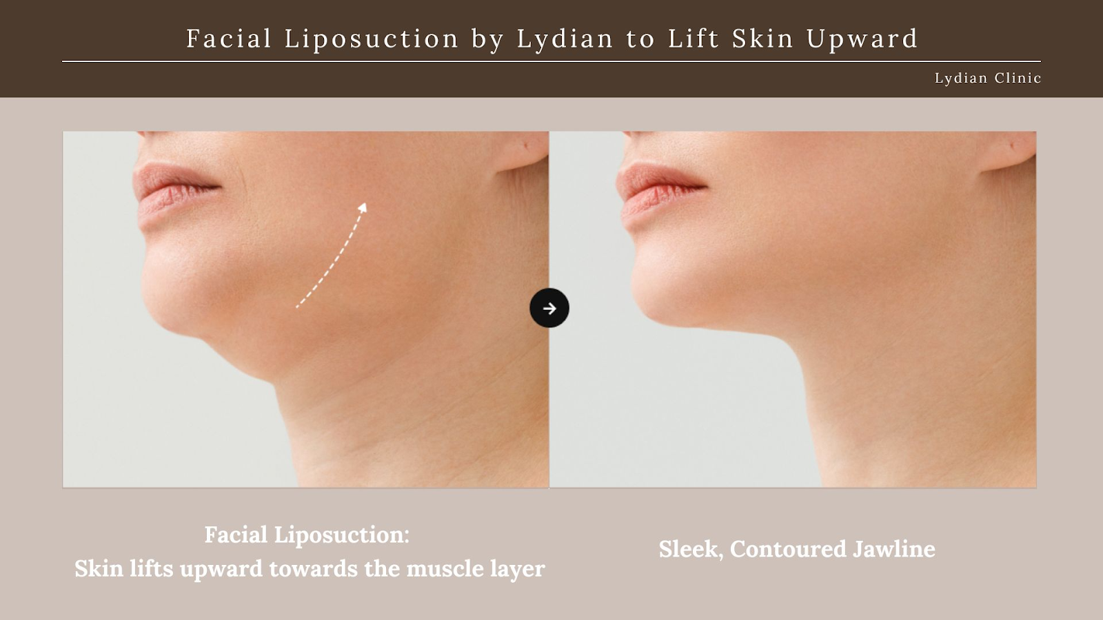 chin liposuction downtime