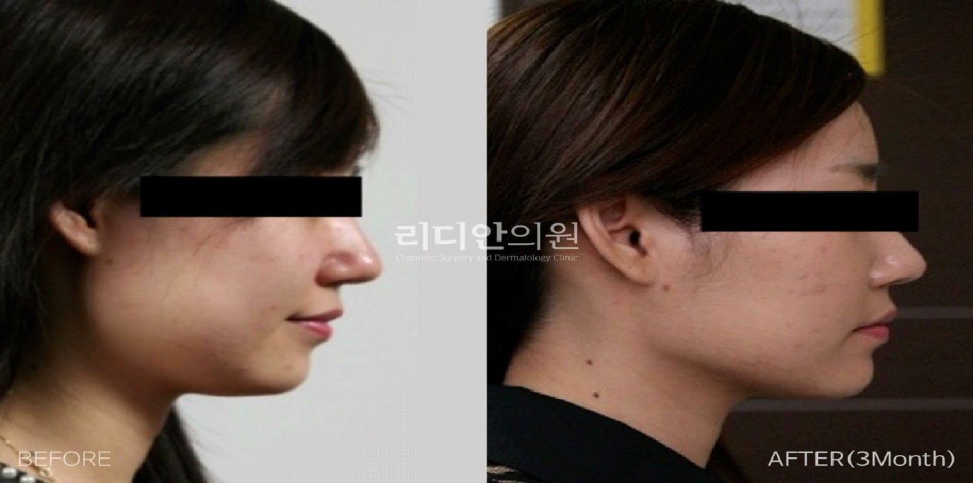 before-and-after-chin-liposuction