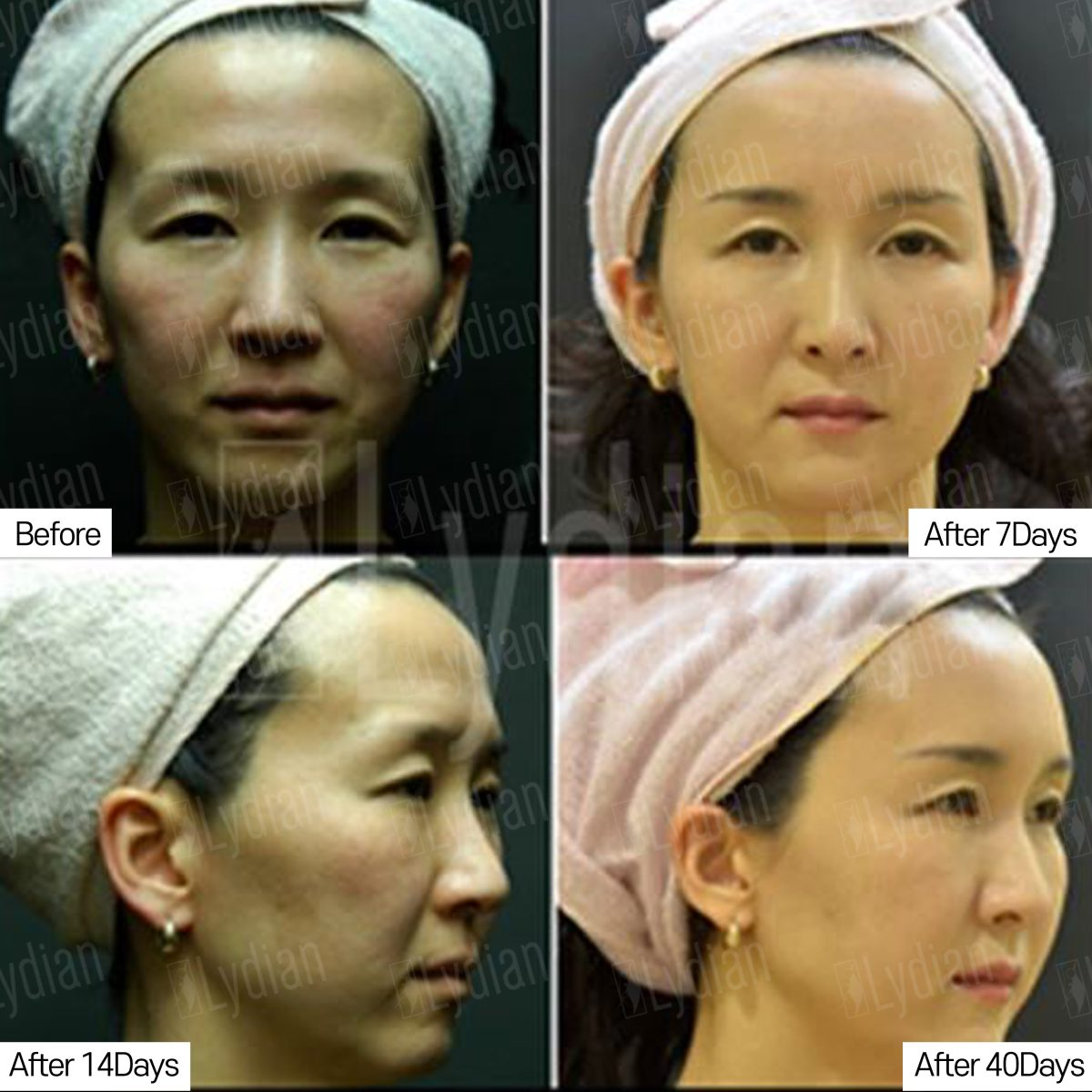 chin-liposuction-recovery