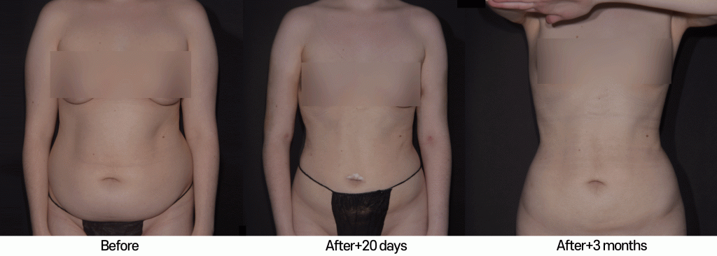 liposuction-and-liposculpture