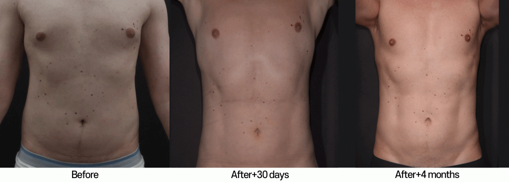 male-liposculpture