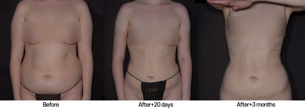 hi-def-liposculpture