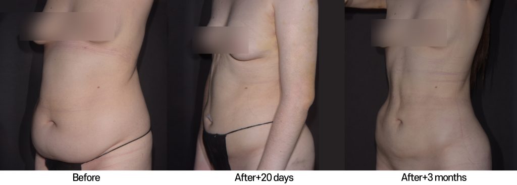 high-def-liposuction