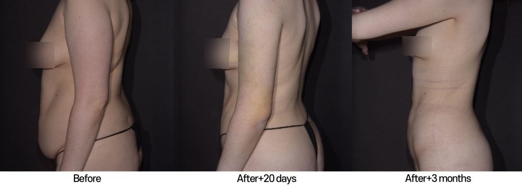 liposculpture-hd