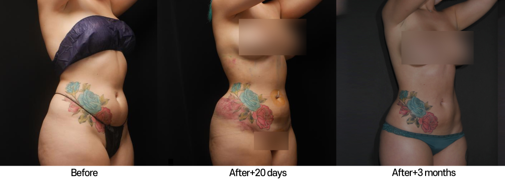 liposculpture-before-after