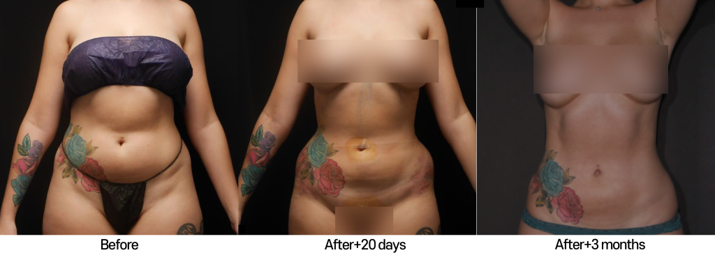 liposculpture-before-after-2