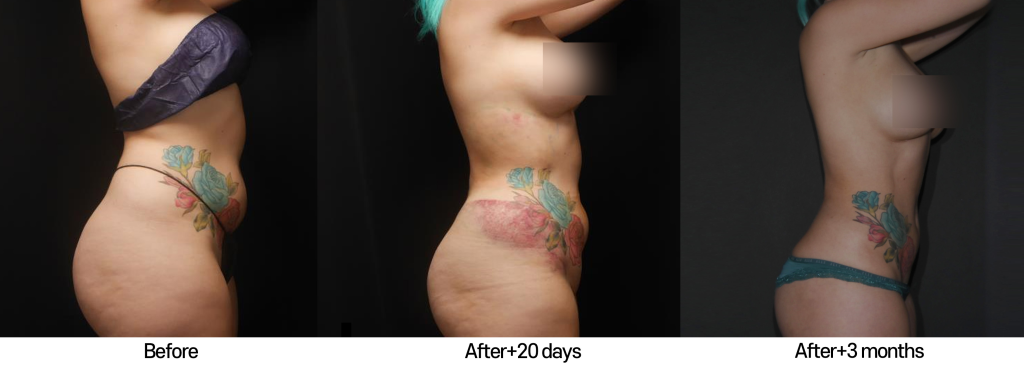 liposculpture-before-after-3