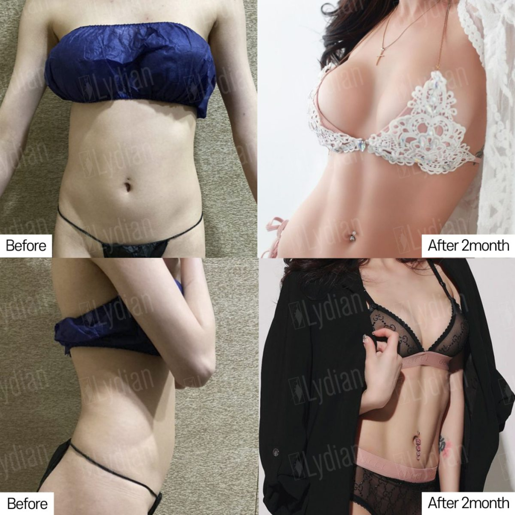 liposculpture-before-and-after