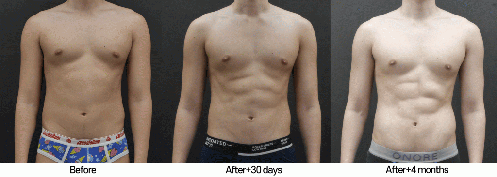 male-liposuction