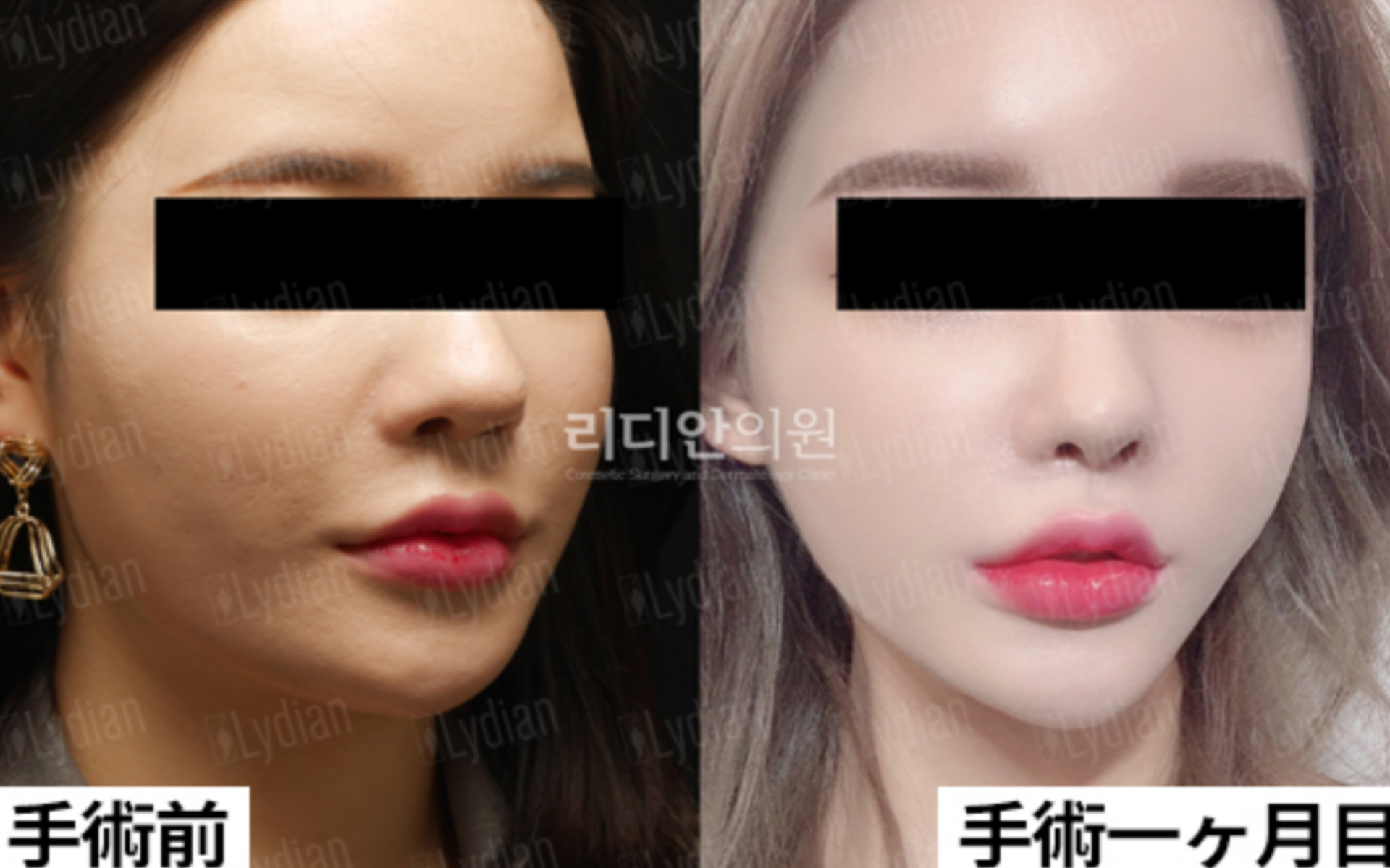 韓国の顔の脂肪吸引効果を高める業界の「秘密」をお教えします。 I リディアンクリニック