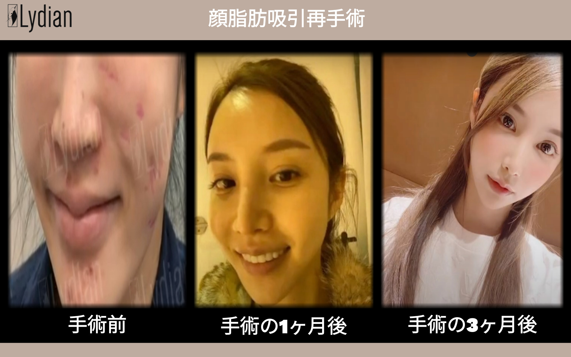 顔 脂肪 吸引 失敗