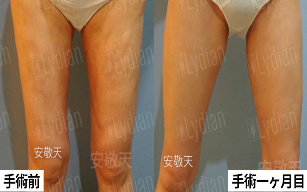 脂肪吸引失敗