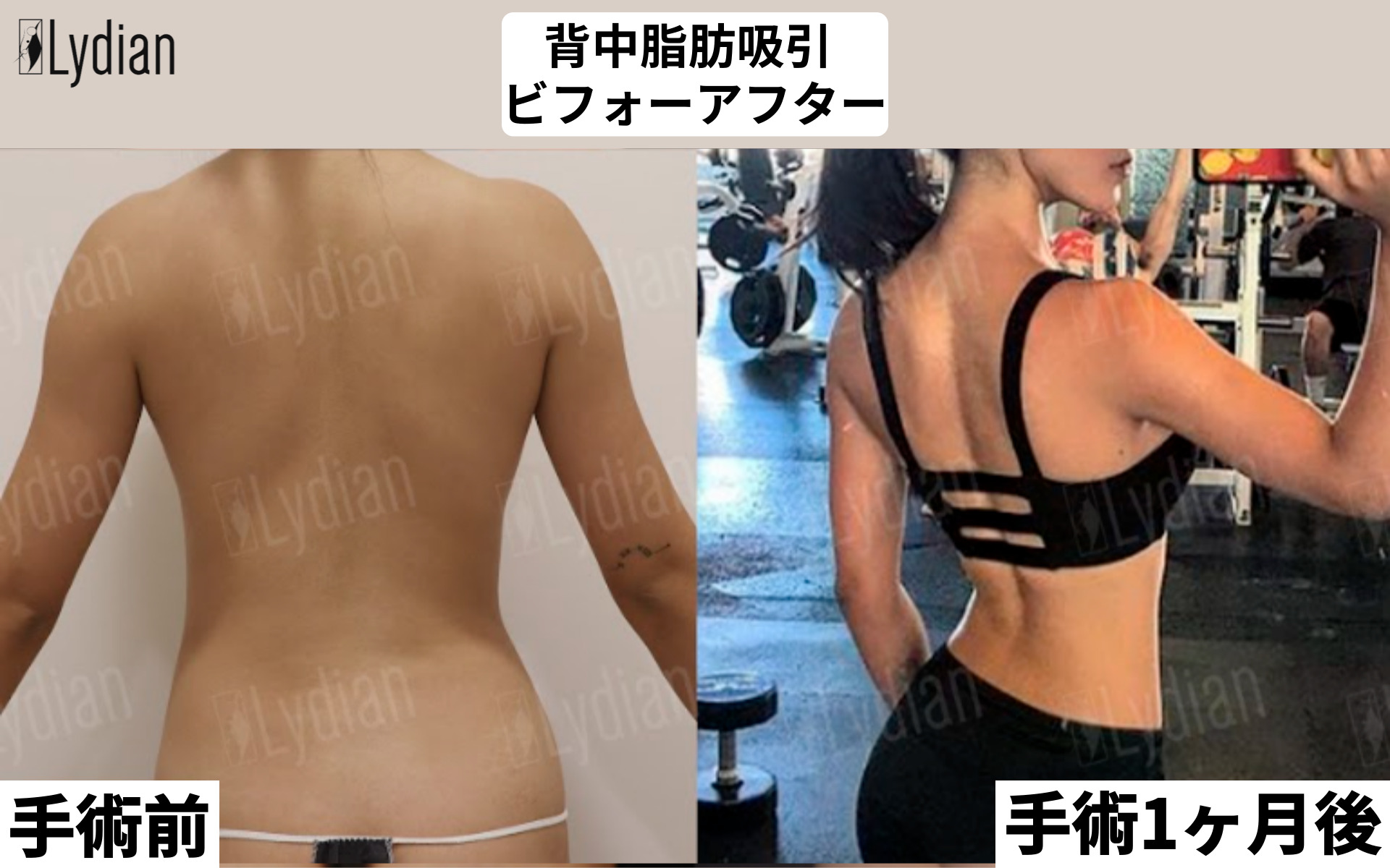 背中脂肪吸引圧迫