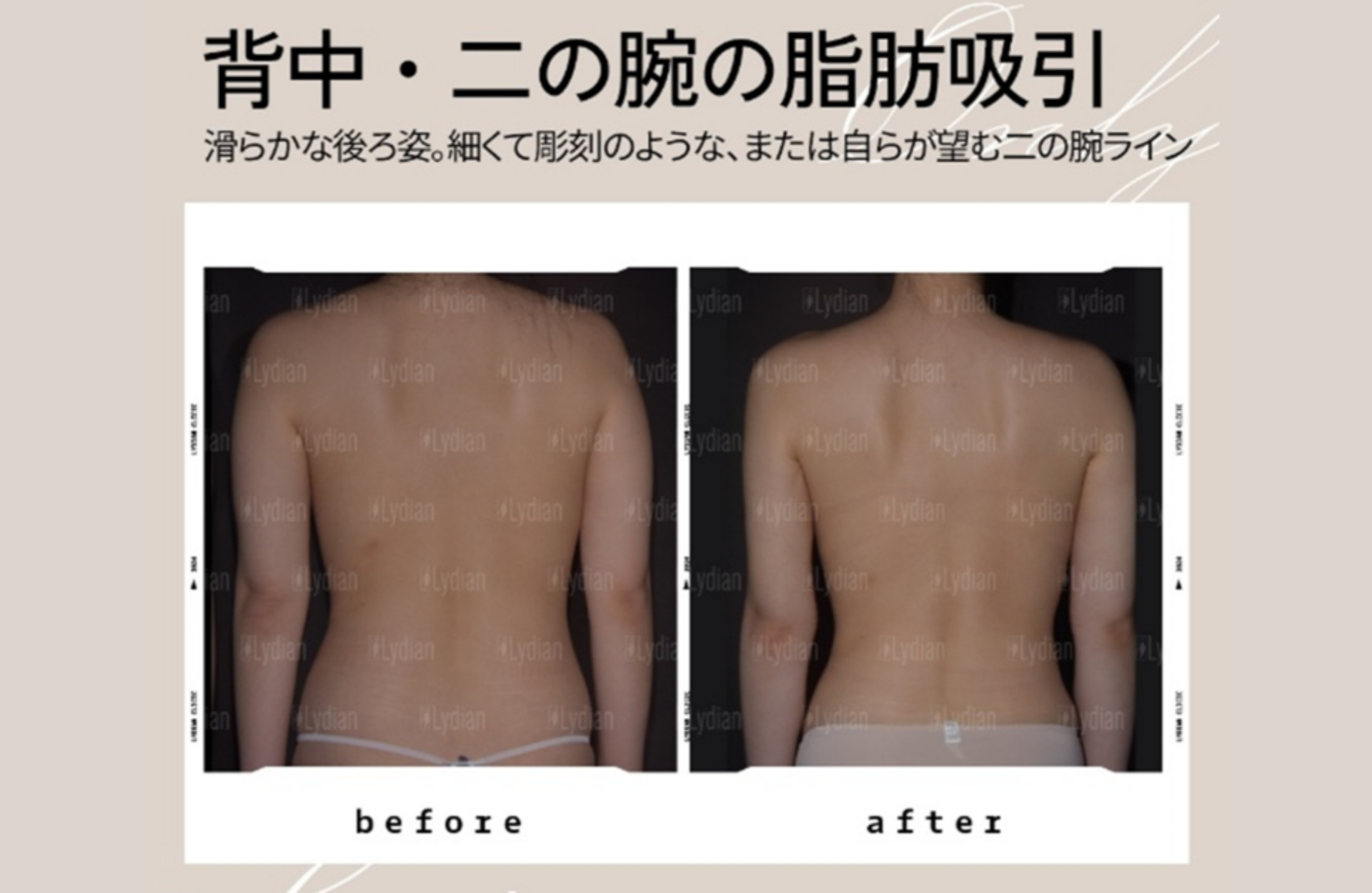 脂肪吸引背中ブログ