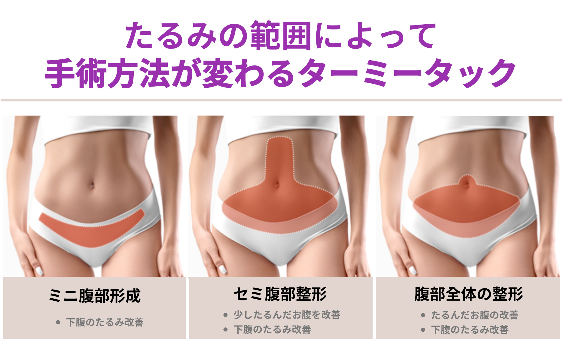 産後 お腹 の 皮