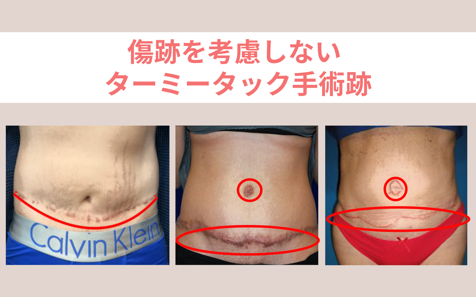 産後 お腹 の 皮