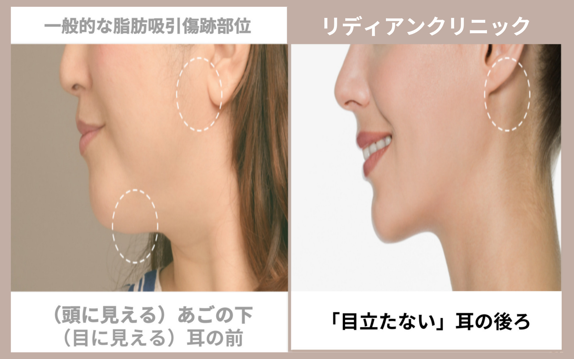 顔面脂肪吸引の傷跡