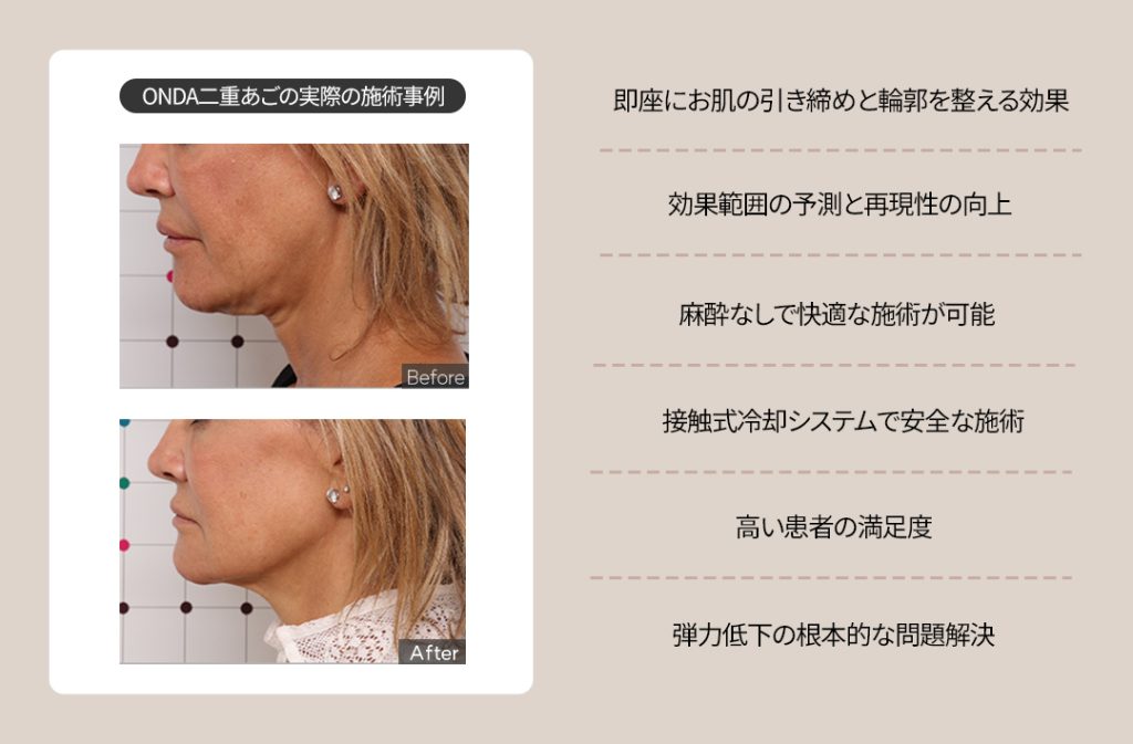 30代・40代の大人女性に人気！ 韓国発・オンダリフトでたるみもシワも