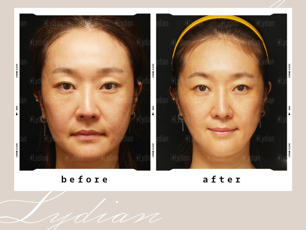 リディアンクリニック 韓国整形 韓国美容整形 脂肪吸引 韓国脂肪吸引 渡韓 渡韓整形 肌管理 韓国美容 韓国美容クリニック 韓国美容外科 脂肪注入 脂肪移植 幹細胞 幹細胞再生 (16)