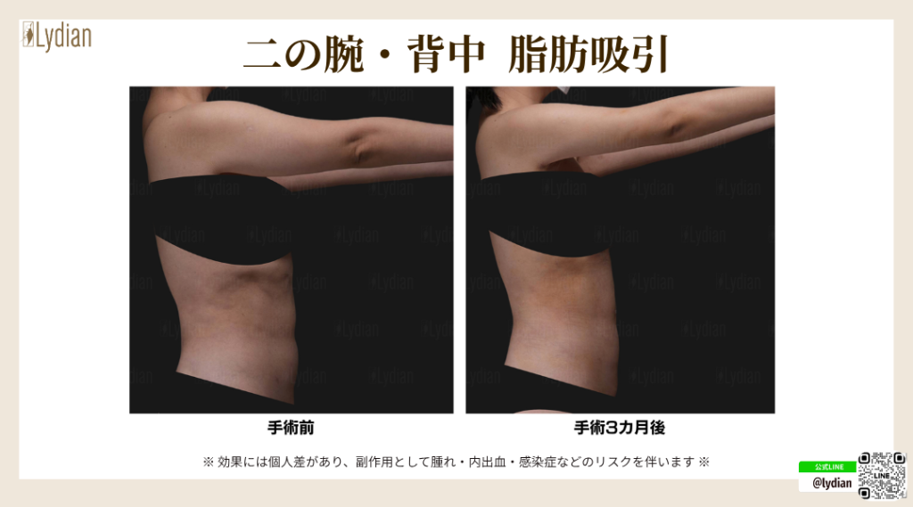 二の腕 脂肪吸引 たるみ 韓国リディアンクリニック リディアンクリニック ワンホール二の腕脂肪吸引 二の腕脂肪吸引 脂肪吸引韓国