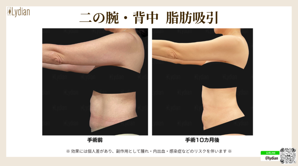 二の腕 脂肪吸引 たるみ 韓国リディアンクリニック リディアンクリニック ワンホール二の腕脂肪吸引 二の腕脂肪吸引 脂肪吸引韓国