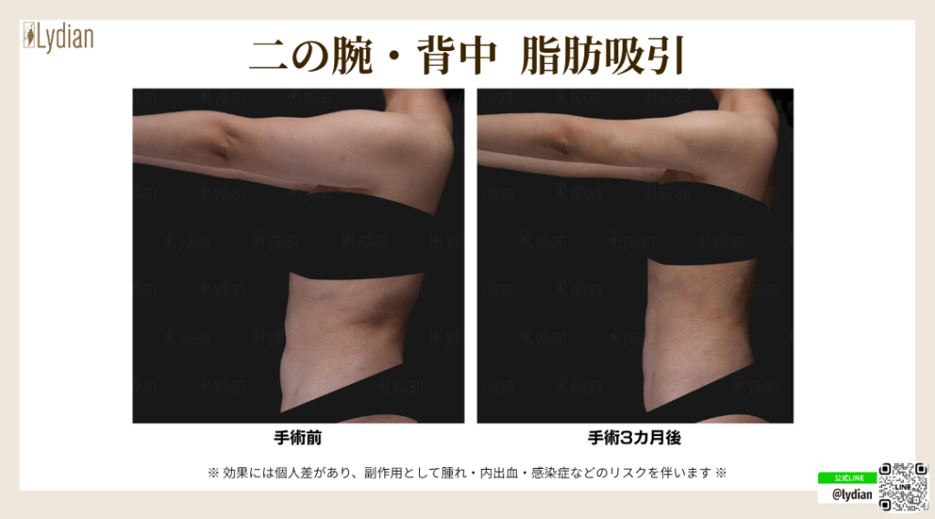 二の腕 脂肪吸引 たるみ 韓国リディアンクリニック リディアンクリニック ワンホール二の腕脂肪吸引 二の腕脂肪吸引 脂肪吸引韓国