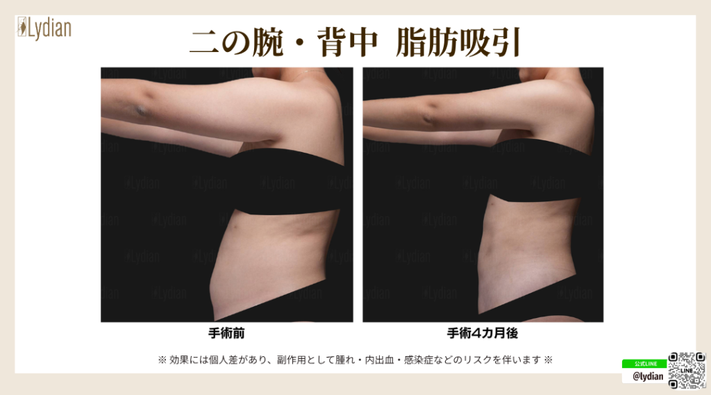二の腕 脂肪吸引 たるみ 韓国リディアンクリニック リディアンクリニック ワンホール二の腕脂肪吸引 二の腕脂肪吸引 脂肪吸引韓国