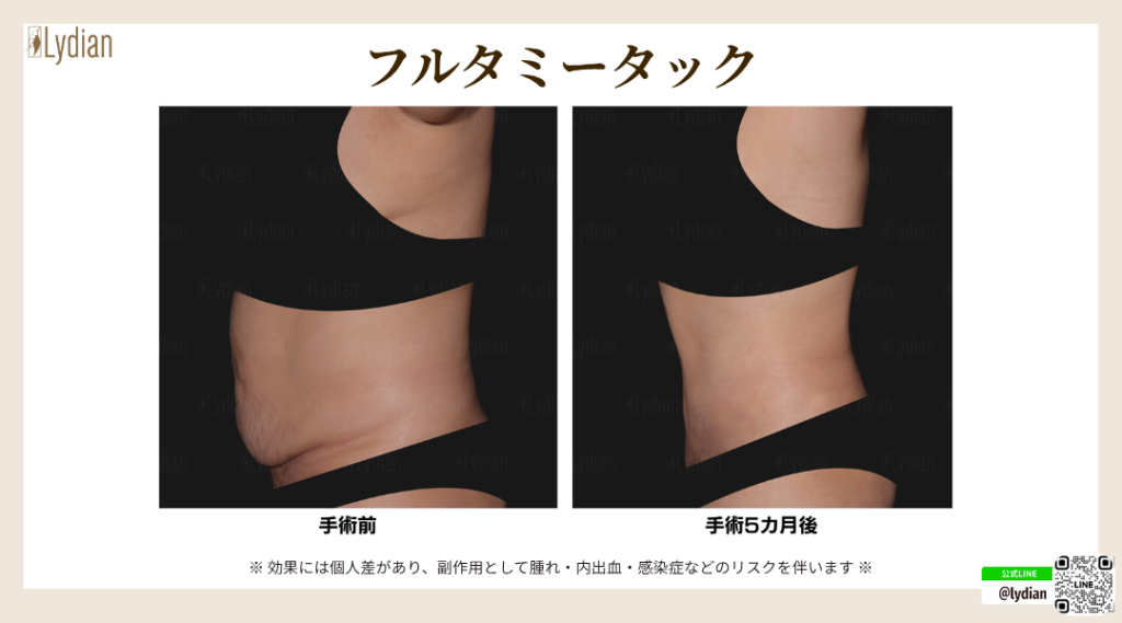 産後 お腹 たるみ 韓国リディアンクリニック リディアンクリニック 産後のお腹のたるみ タミータック 腹壁形成術 お腹のたるみ取り お腹痩せ