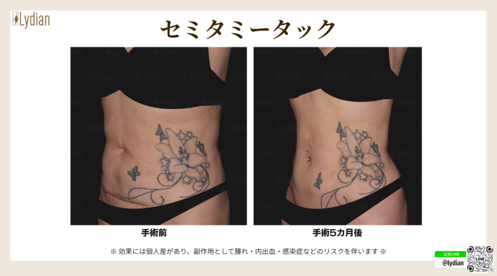 産後 お腹 たるみ 韓国リディアンクリニック リディアンクリニック 産後のお腹のたるみ タミータック 腹壁形成術 お腹のたるみ取り お腹痩せ
