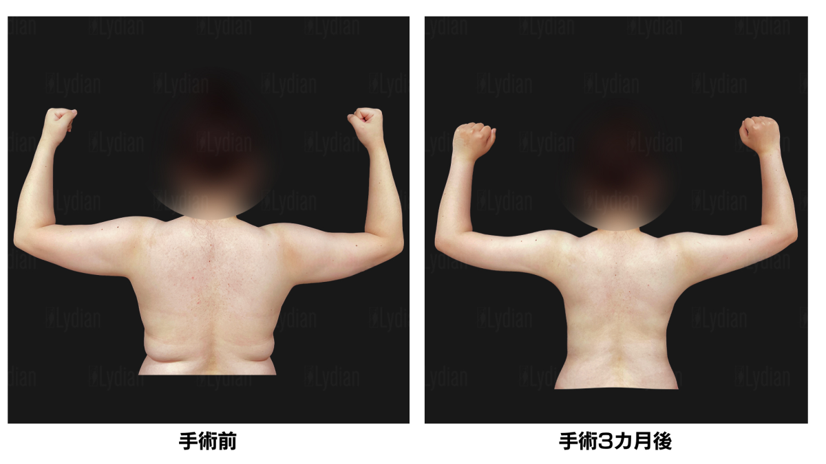 韓国リディアンクリニック リディアンクリニック ワンホール二の腕脂肪吸引 二の腕脂肪吸引 韓国脂肪吸引 二の腕痩せ (1)