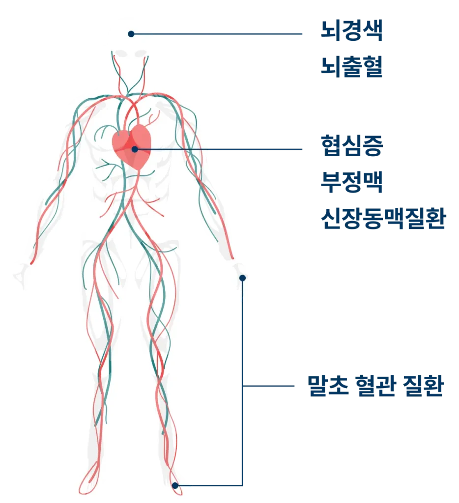 Medical illustration of vascular disease