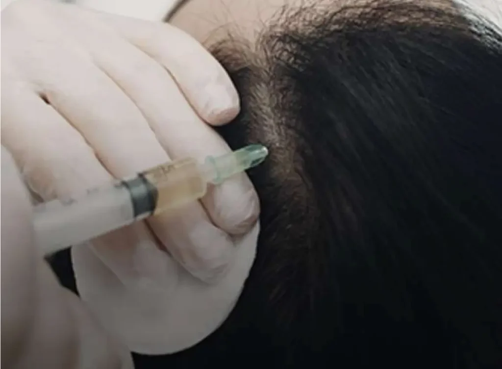 Patient receiving stem cell hair loss treatment in clinic