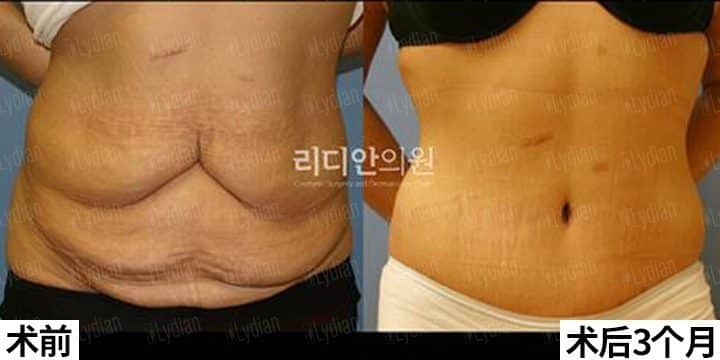 tummy tuck before and after results
