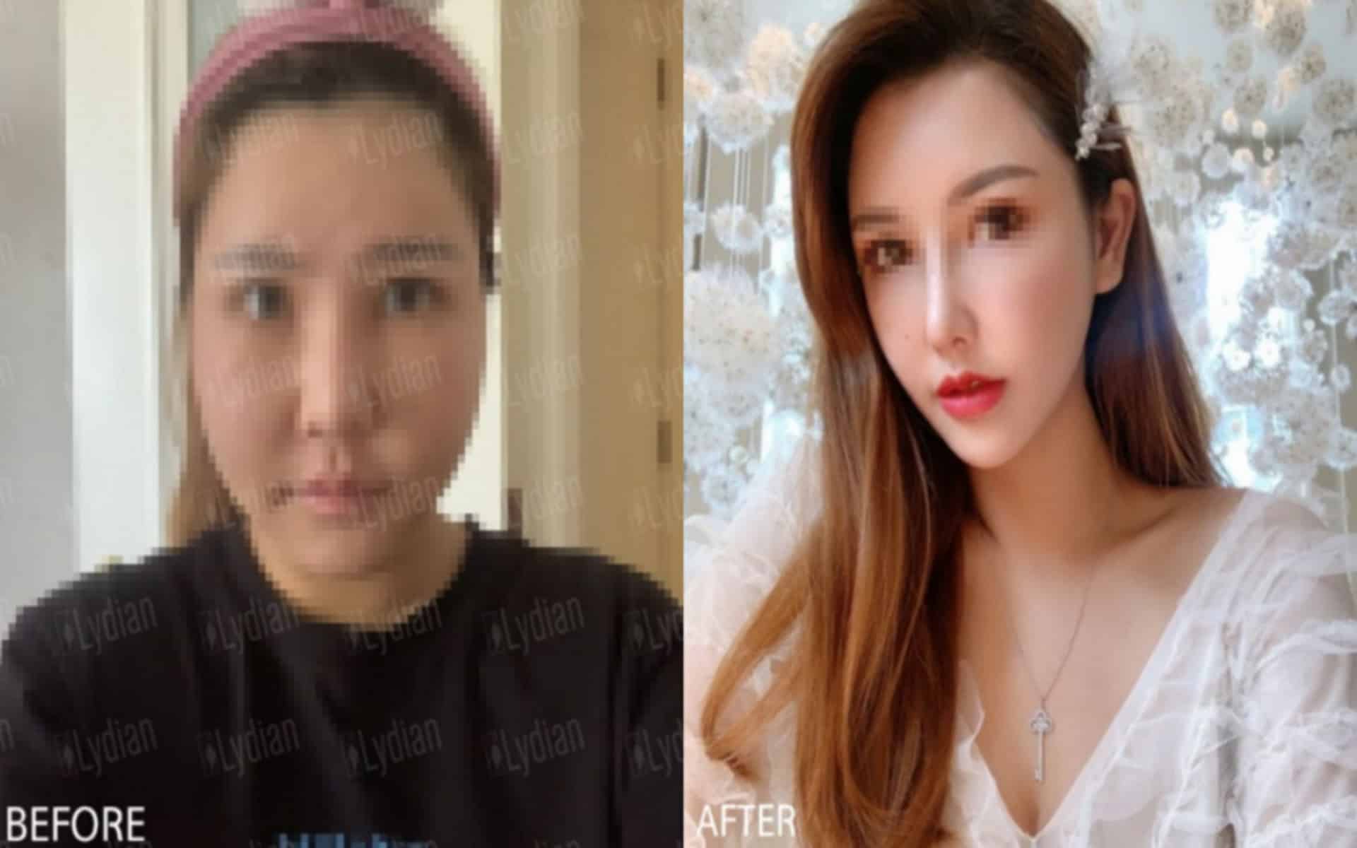 臉部抽脂手術2