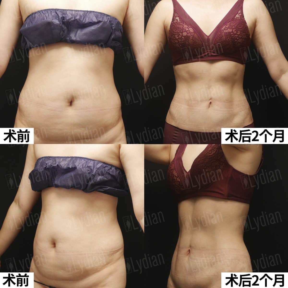 abdomen liposuction before and after results, real patient transformation