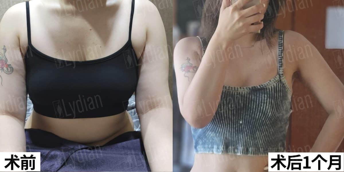 female breast augmentation before and after results