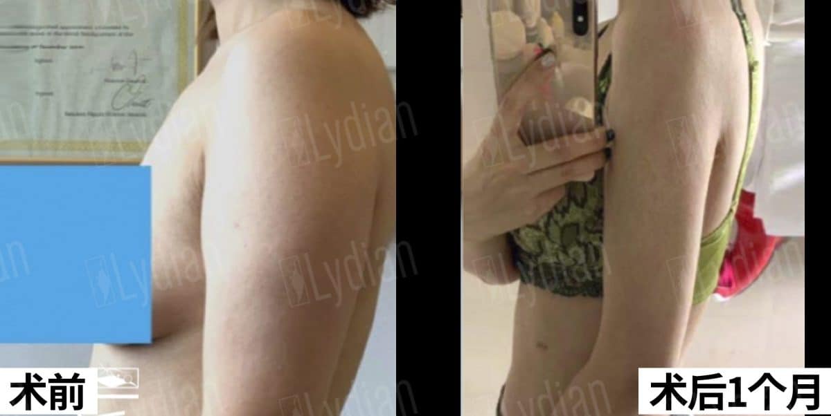 before and after female breat following breast augmentation