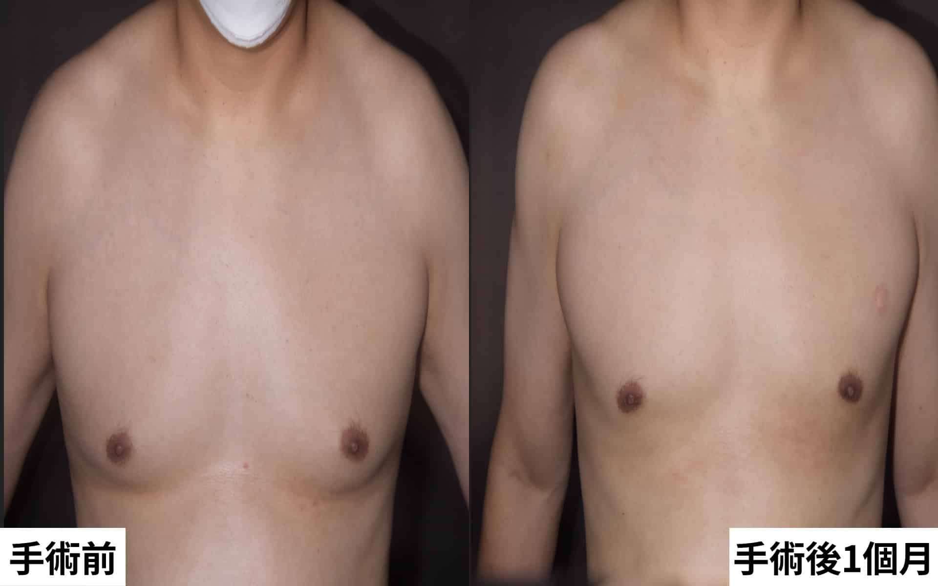 男性女乳症