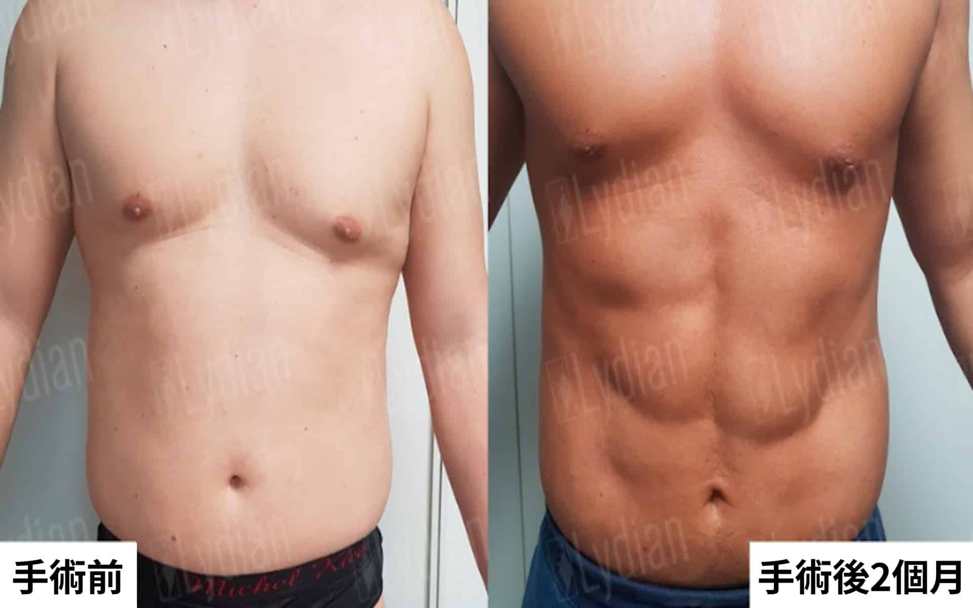 腹部整形手術