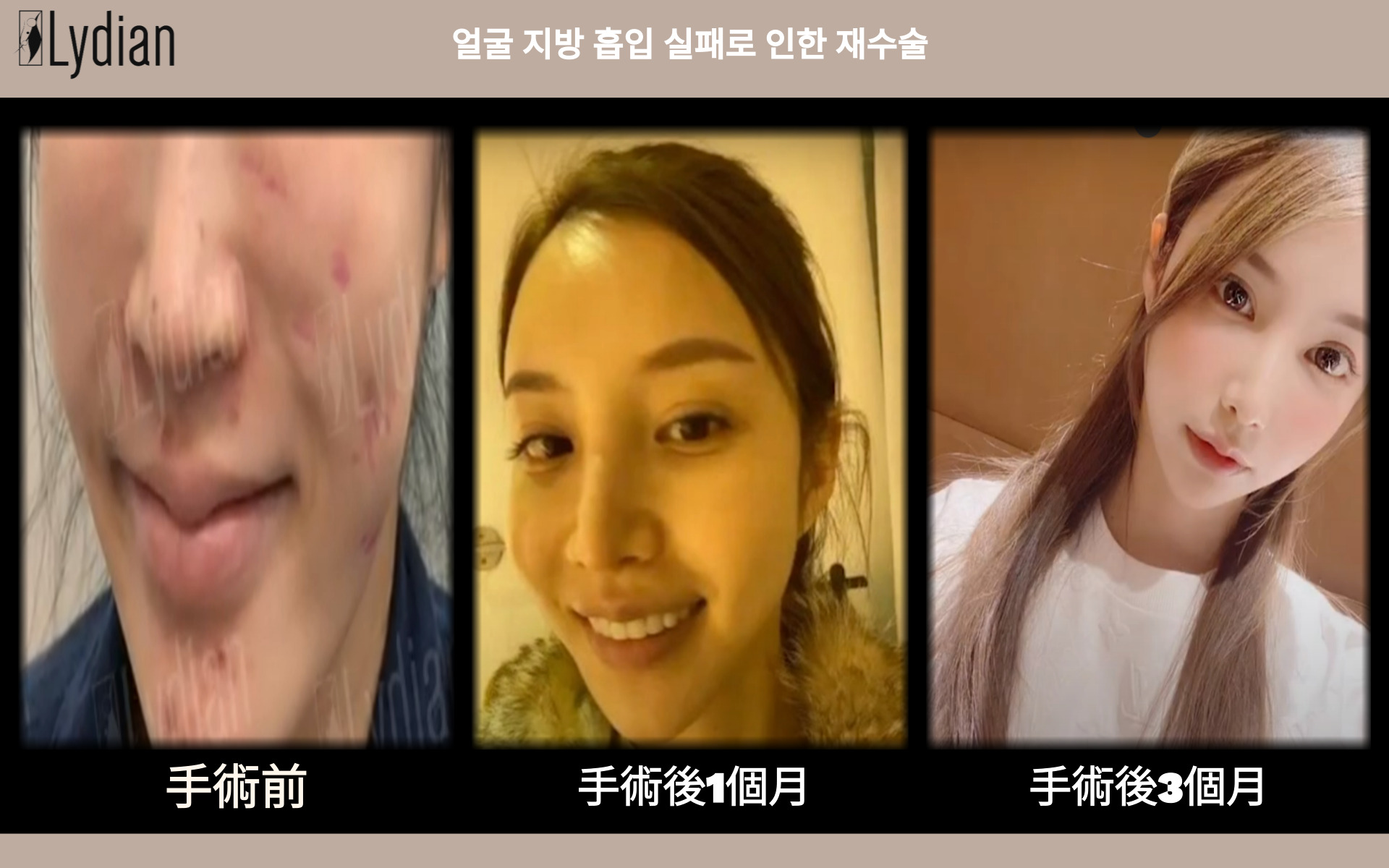 臉部抽脂修復手術