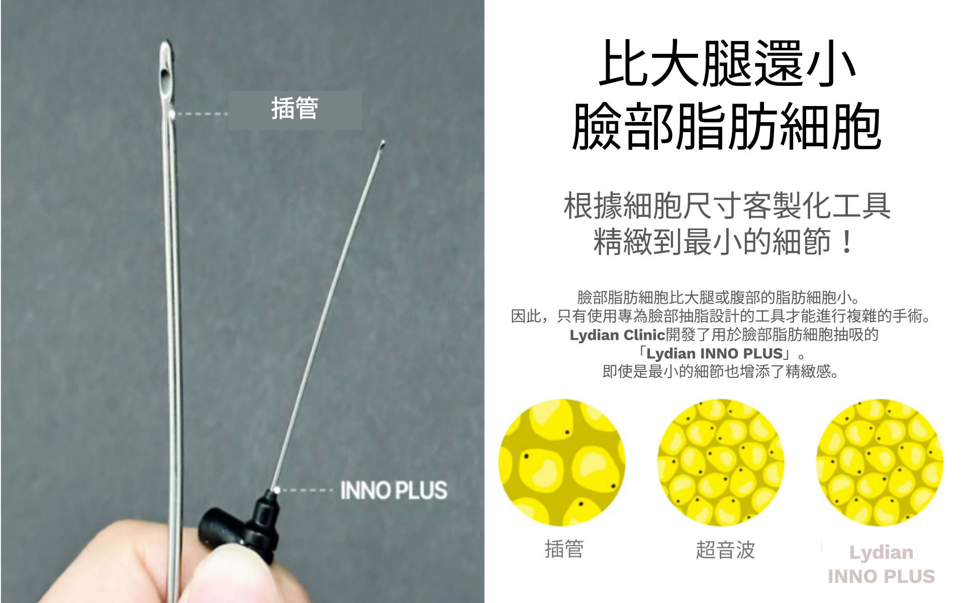 臉部抽脂成功