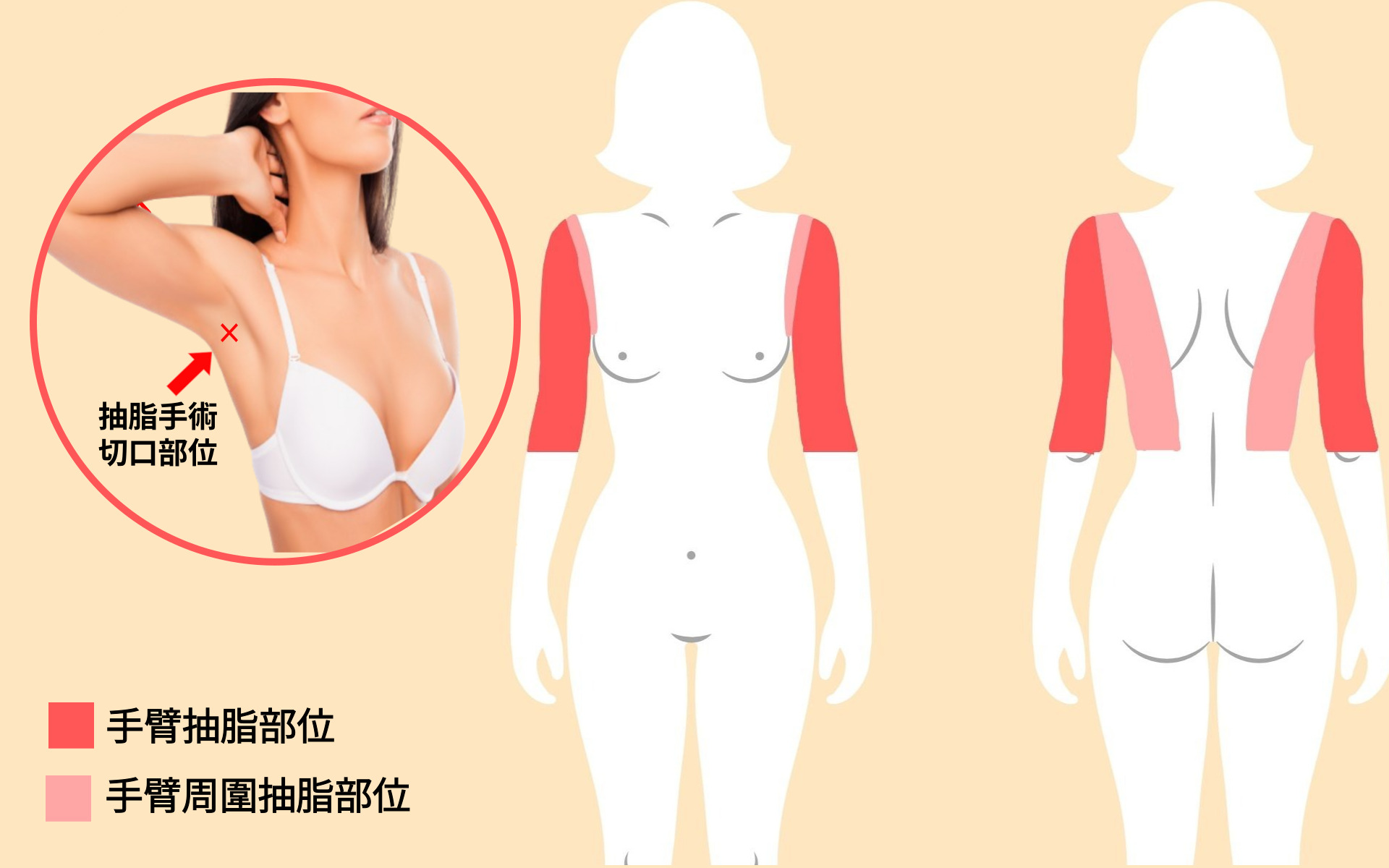 手臂抽脂手術