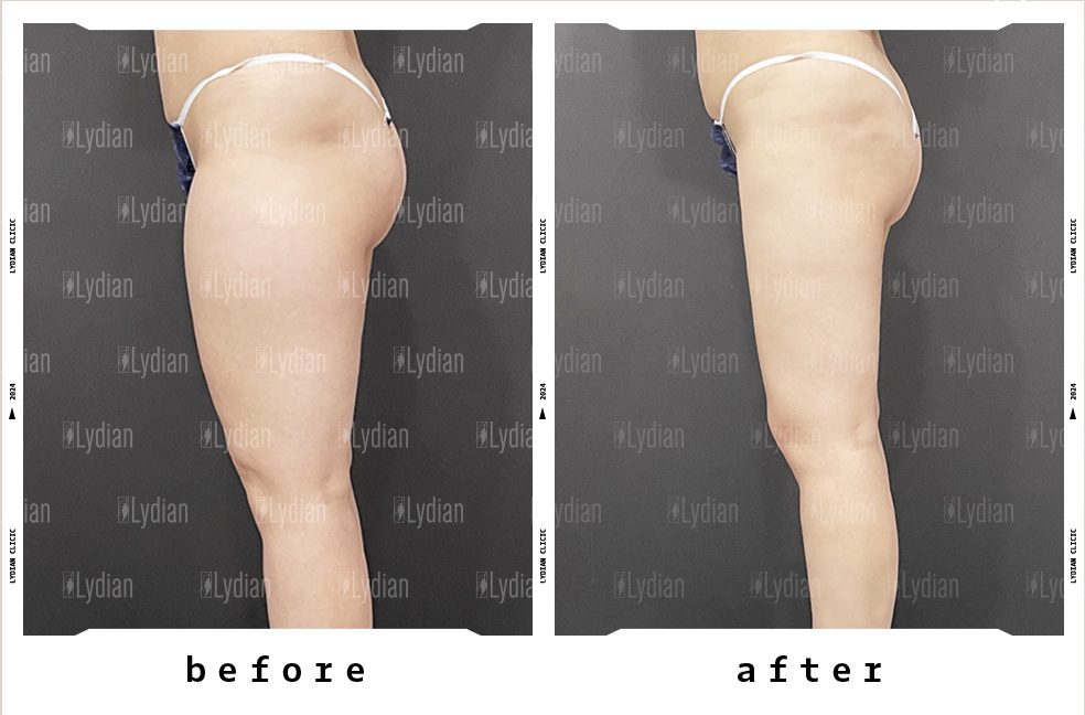 thigh gap before and after following liposuction